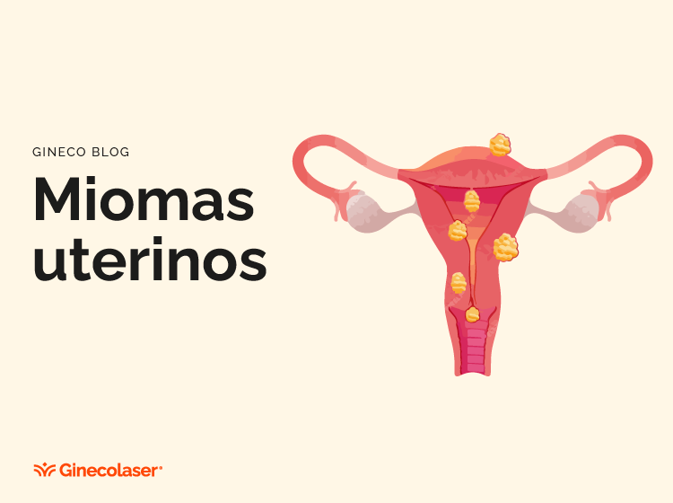 Miomas uterinos 