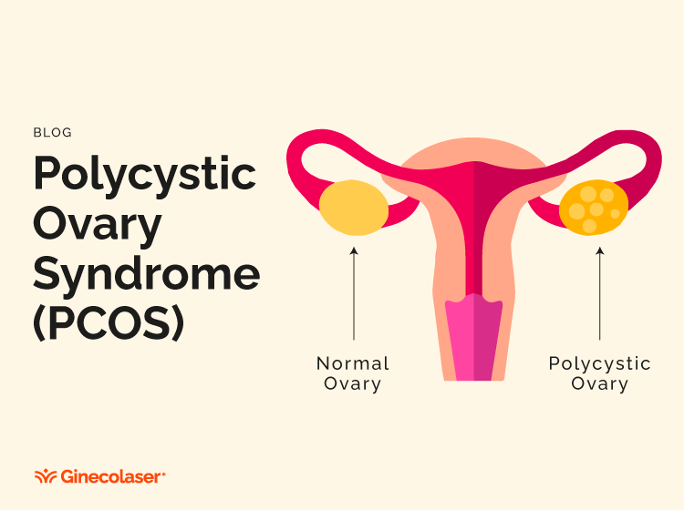 Polycystic Ovary Syndrome (PCOS) and its Impact on Health Throughout Life.