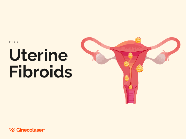 Uterine Fibroids