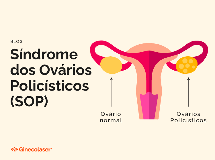 Síndrome dos Ovários Policísticos (SOP) e seu impacto na saúde ao longo da vida