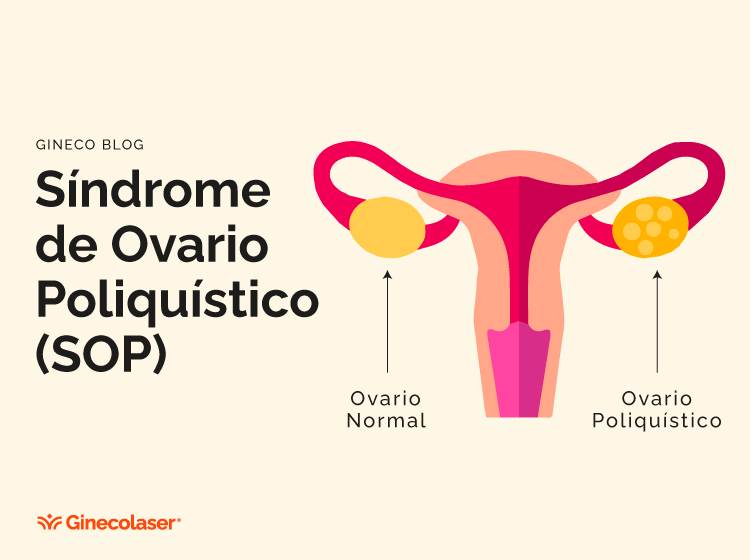 Síndrome de Ovario Poliquístico (SOP) y su impacto en la salud a lo largo de la vida.
