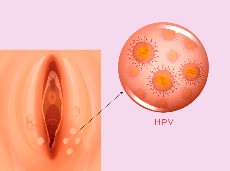 HPV (Verrugas y lesiones en Papanicolau)