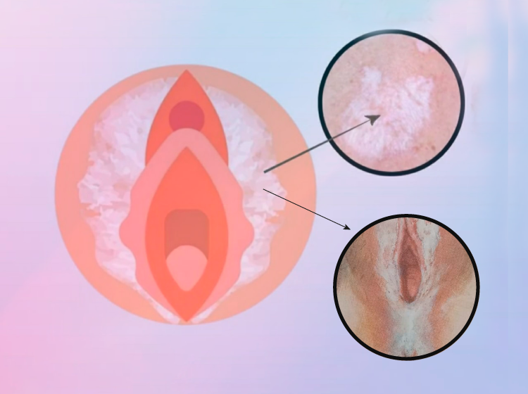 Lichen Sclerosus (LS)