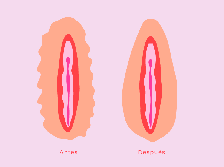 Endolifting of the labia majora