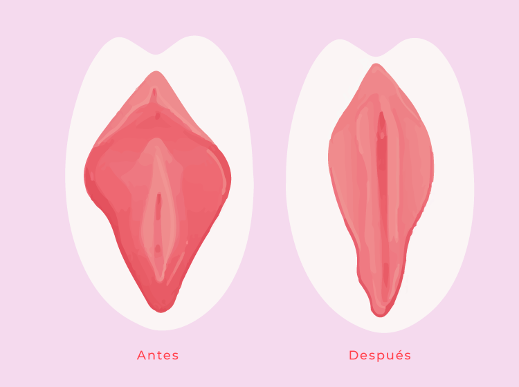Labioplastia sin cicatriz