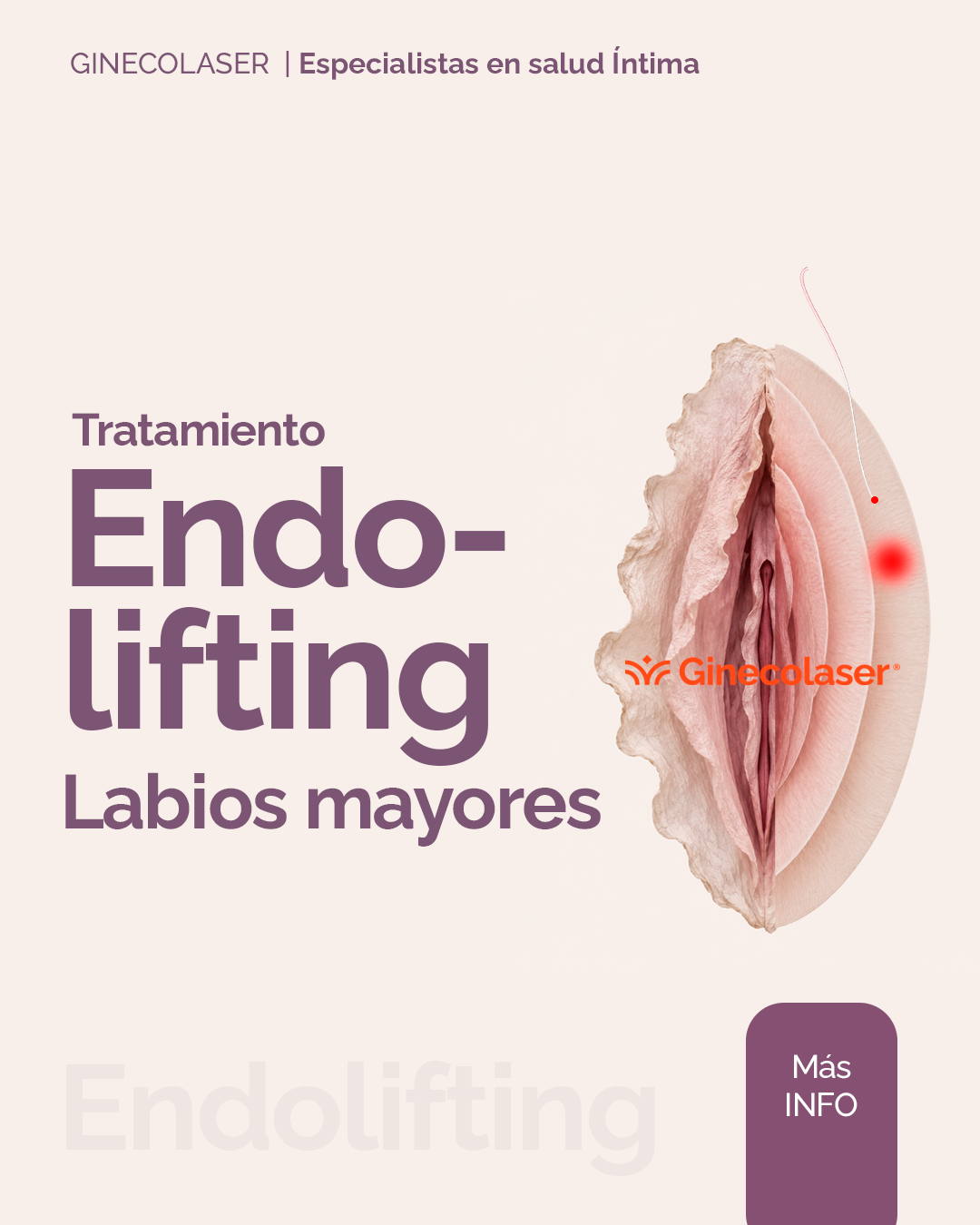 Endolifting labios mayores