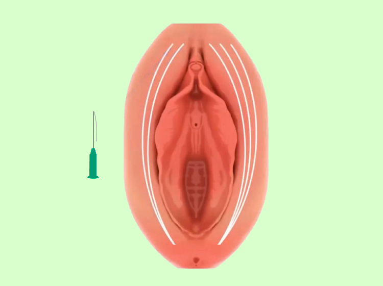 Hilos tensores en vulva, efecto lifting