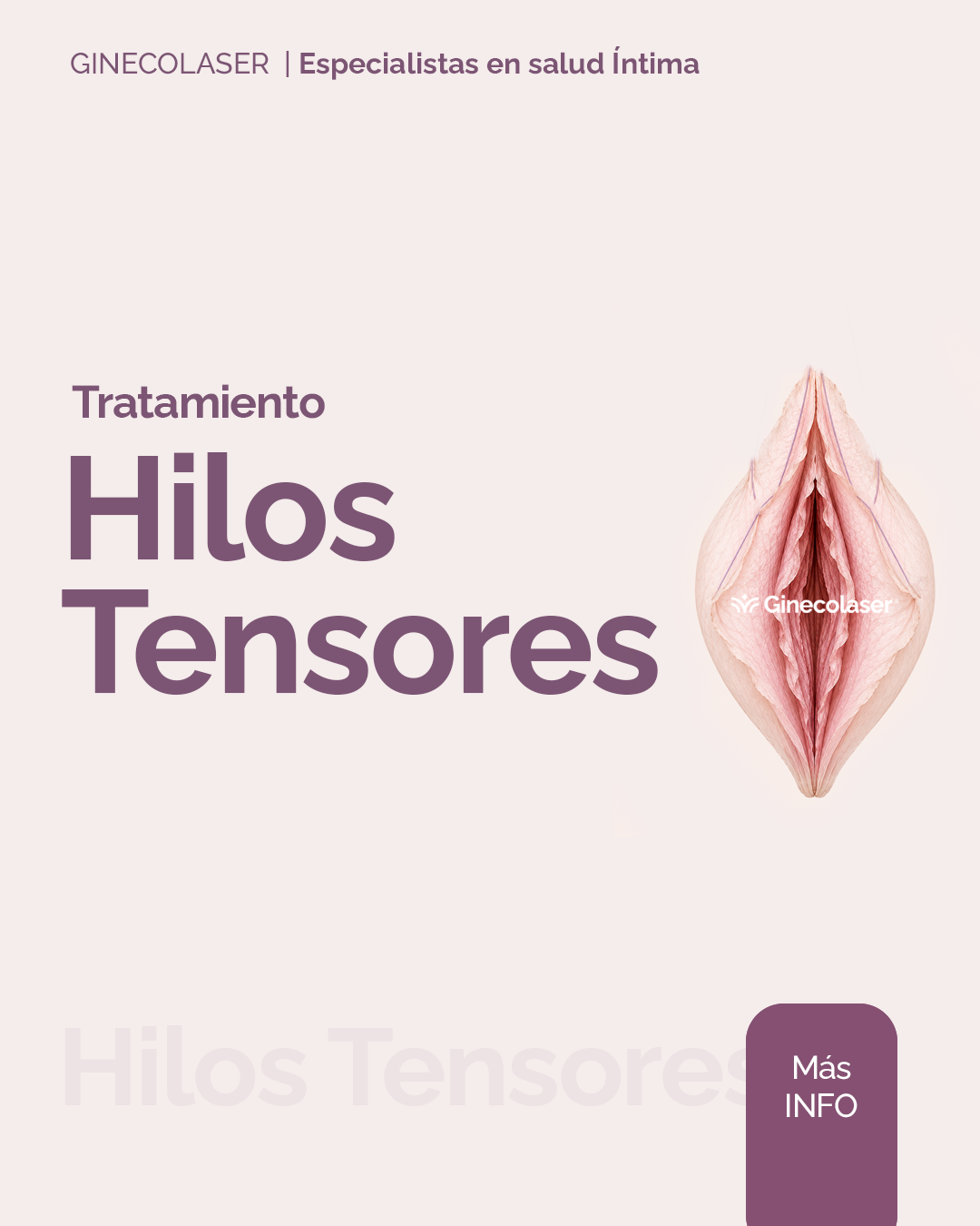 Hilos tensores en vulva, efecto lifting