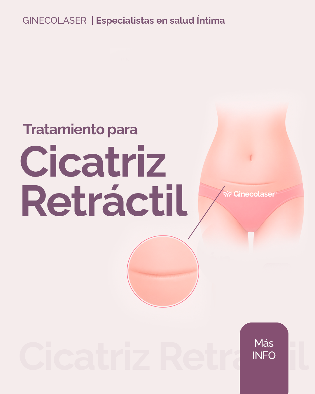 Corrección de cicatriz retráctil (cesárea)