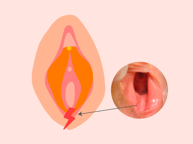 Vulvar Fissures