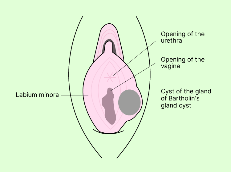 Bartholin's Glands