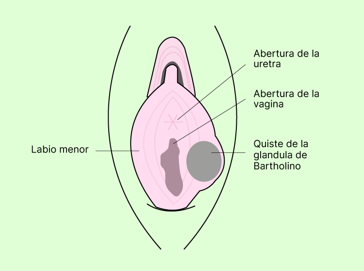 Quiste de la glándula de Bartholino