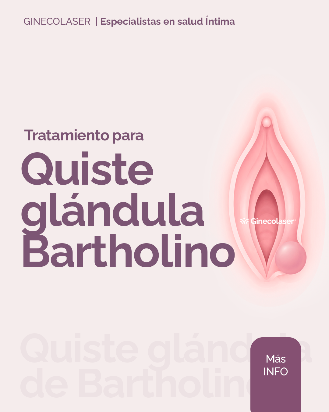 Quiste de la glándula de Bartholino